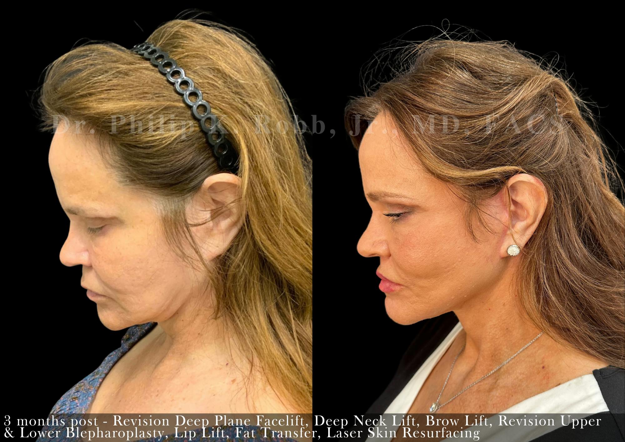 Brow Lift Before & After Gallery - Patient 427304 - Image 4