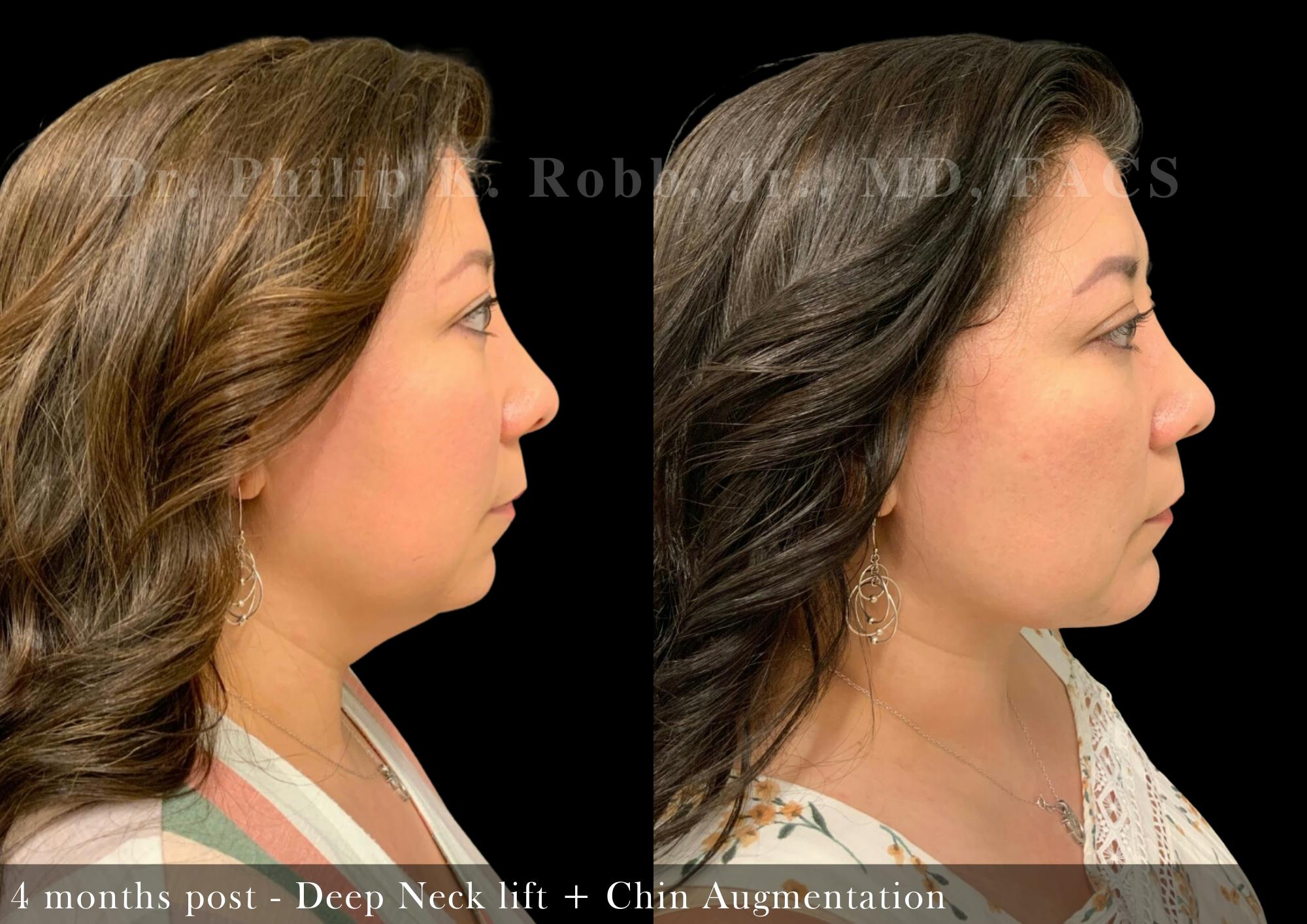 Chin Augmentation Before & After Gallery - Patient 271706 - Image 5