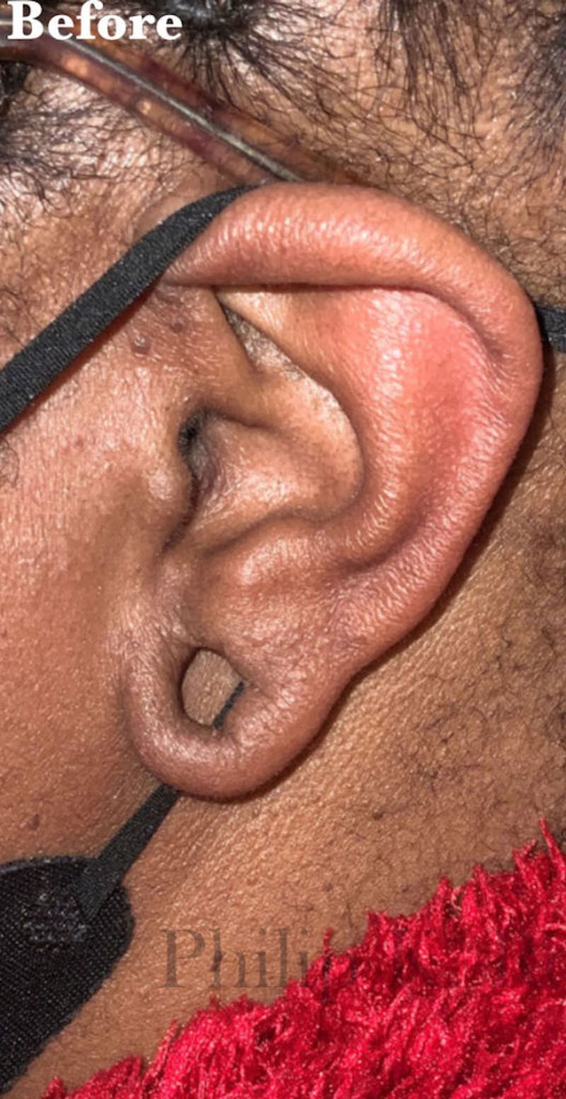 Ear Lobe Repair Before & After Gallery - Patient 425934 - Image 1
