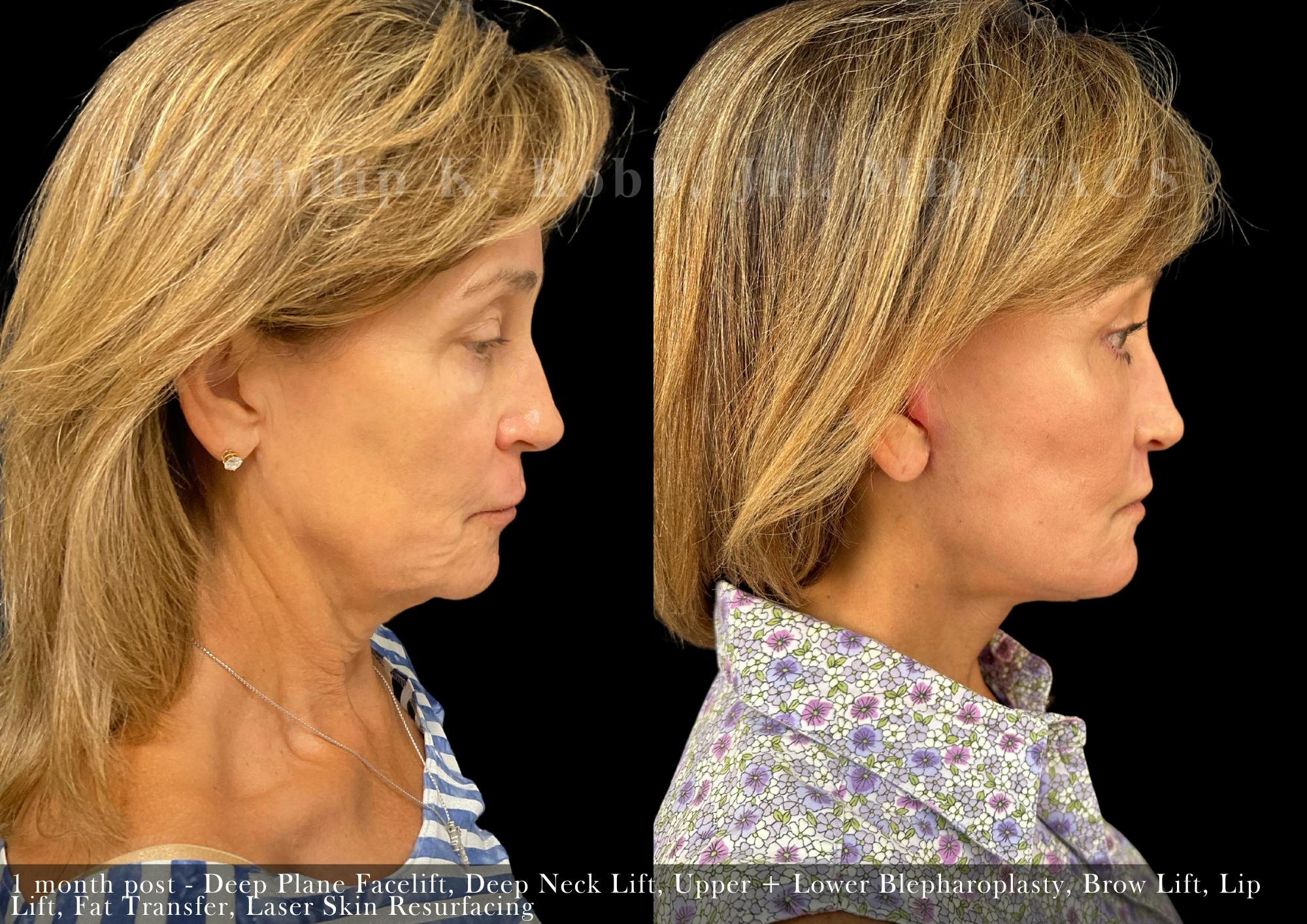 Facial Implants & Fat Transfer Before & After Gallery - Patient 284452 - Image 7