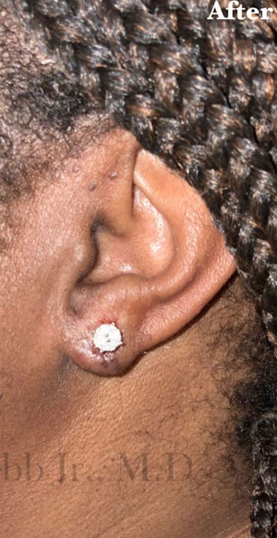 Ear Lobe Repair Before & After Gallery - Patient 425934 - Image 2