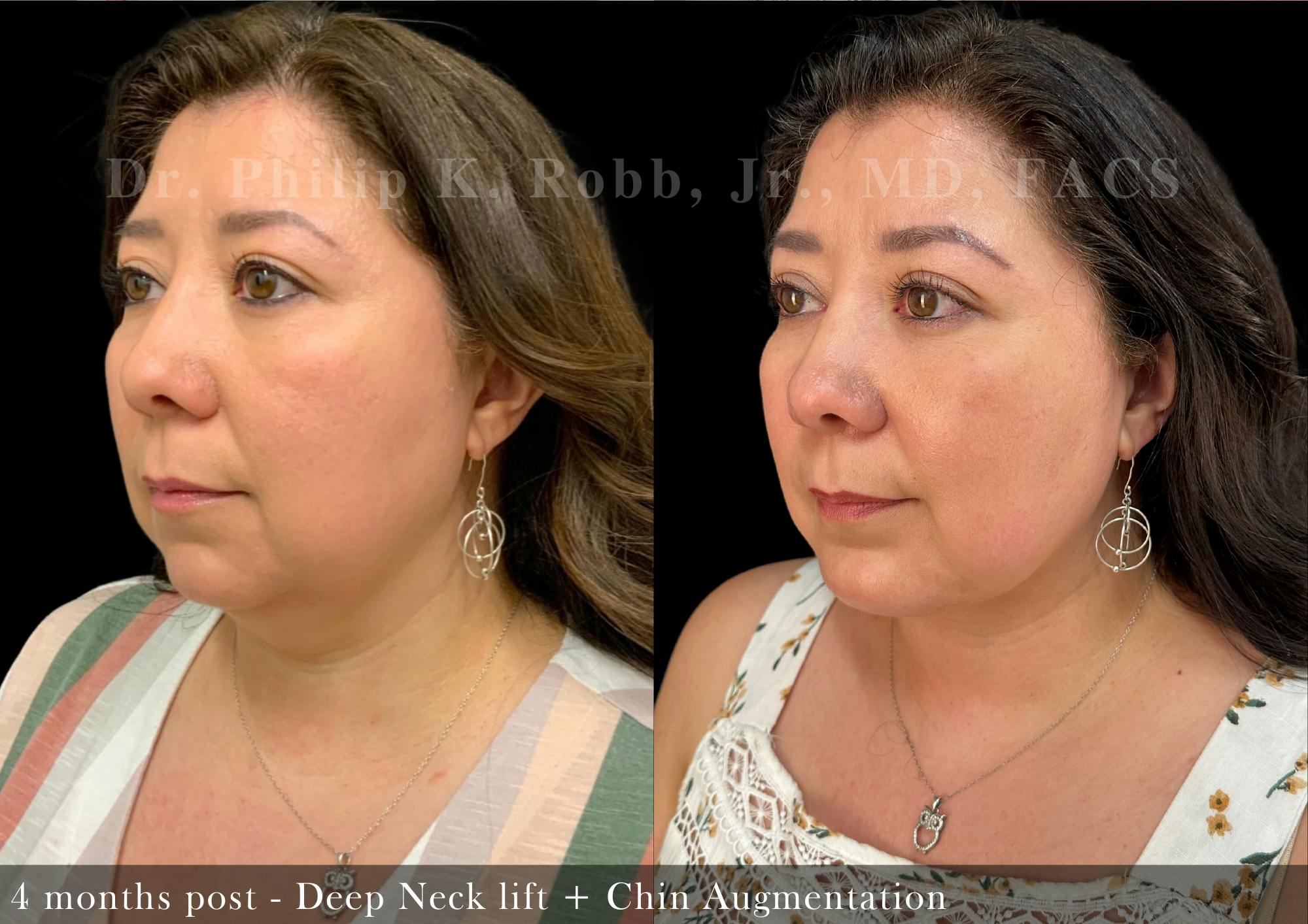 Chin Augmentation Before & After Gallery - Patient 271706 - Image 2
