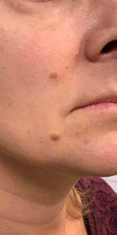 Mole Vaporization Before & After Gallery - Patient 680931 - Image 1