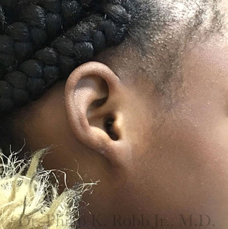 Ear Lobe Repair Before & After Gallery - Patient 175416 - Image 2