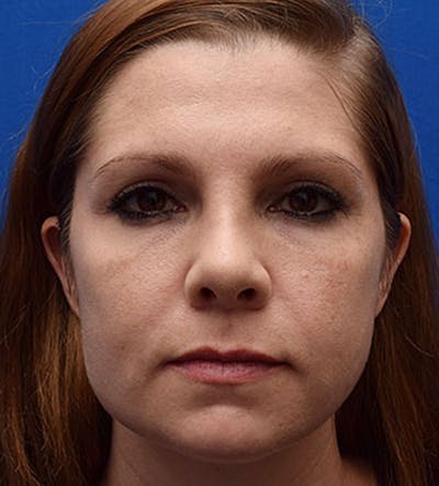 Facial Implants & Fat Transfer Before & After Gallery - Patient 425608 - Image 1