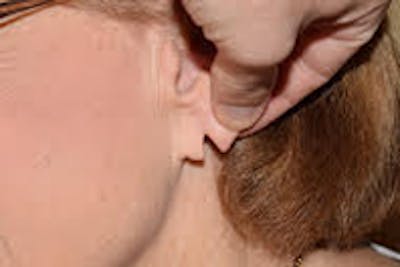 Ear Lobe Repair Before & After Gallery - Patient 738641 - Image 1