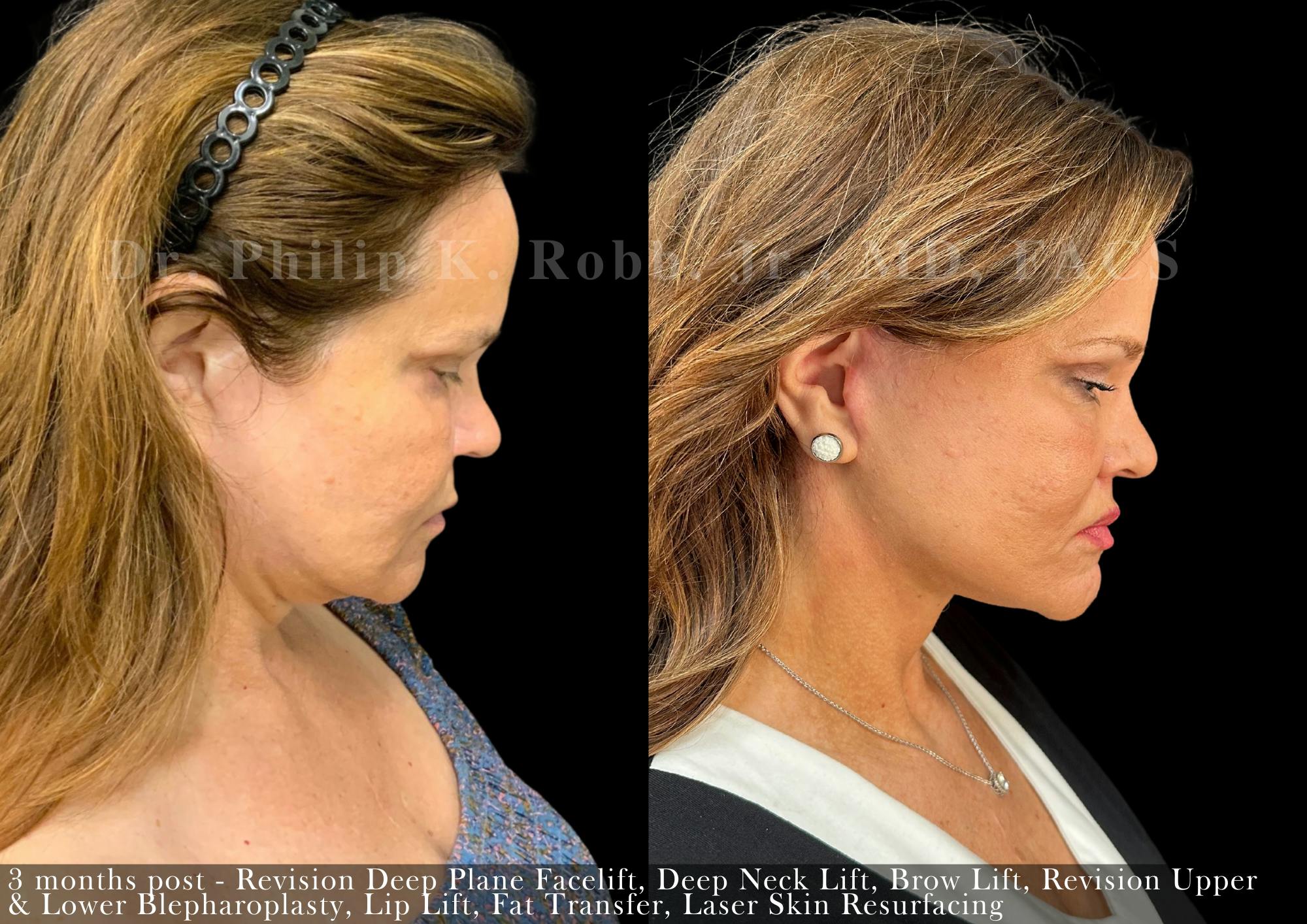 Facelift Before & After Gallery - Patient 694066 - Image 7