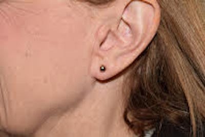 Ear Lobe Repair Before & After Gallery - Patient 738641 - Image 2