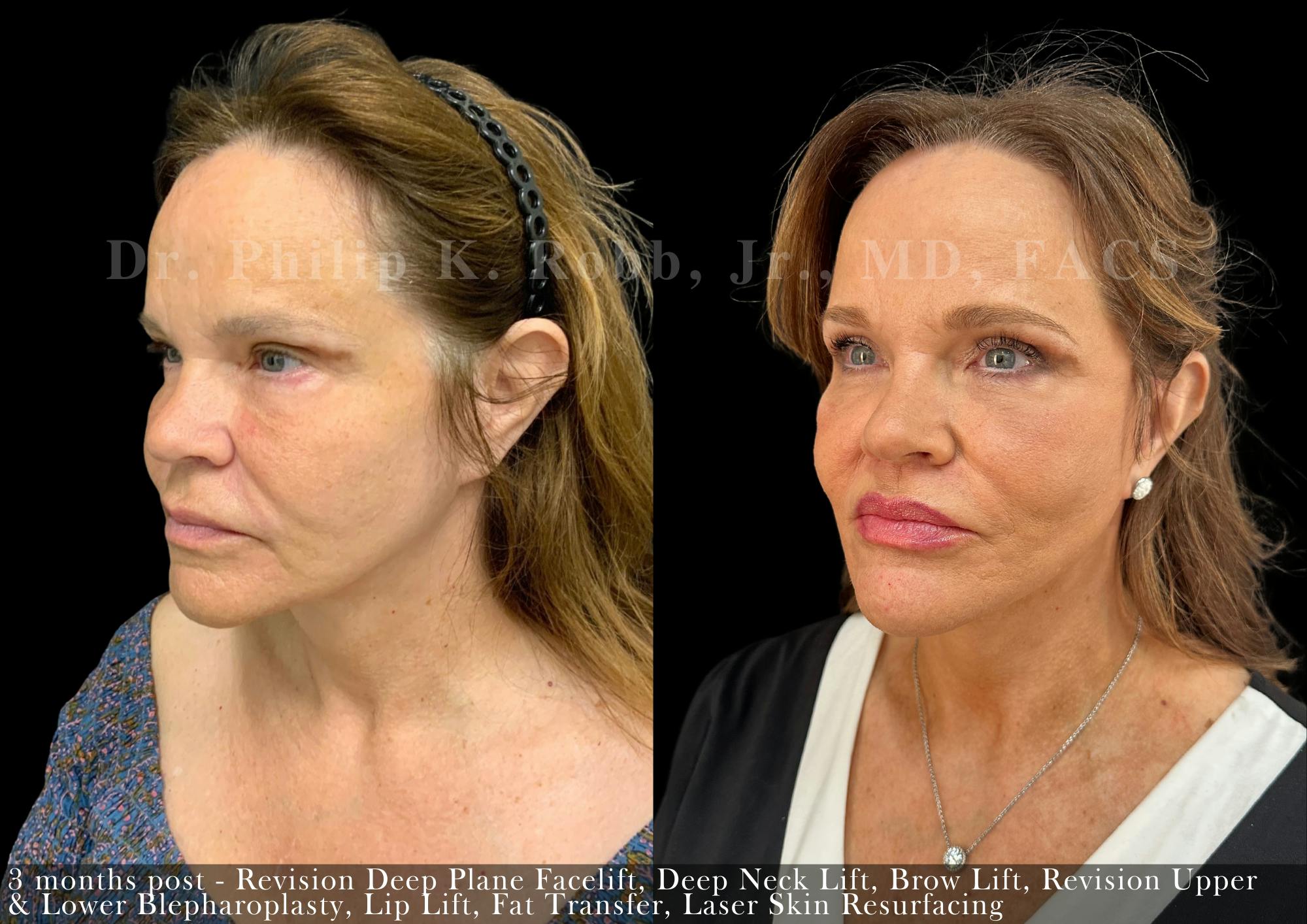 Brow Lift Before & After Gallery - Patient 427304 - Image 2