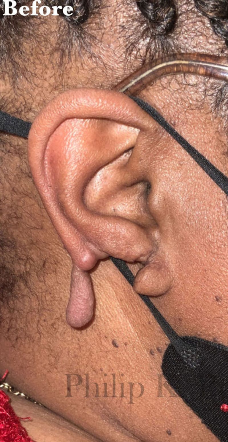 Ear Lobe Repair Before & After Gallery - Patient 219675 - Image 1