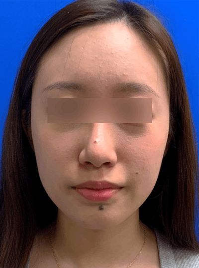 Skin Lesion Removal Before & After Gallery - Patient 194262 - Image 1