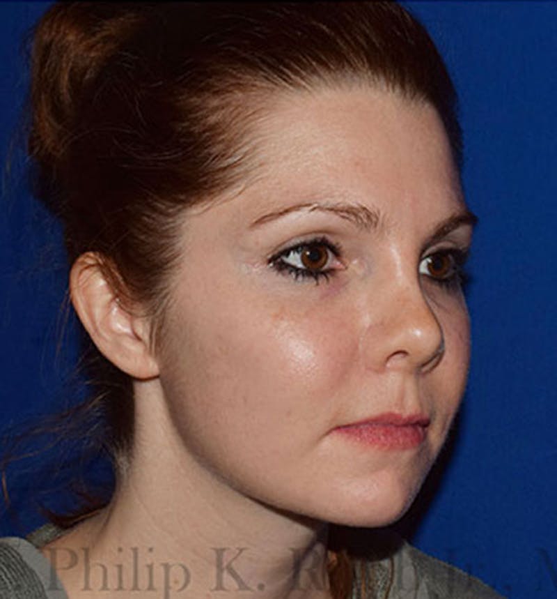 Facial Implants & Fat Transfer Before & After Gallery - Patient 425608 - Image 4