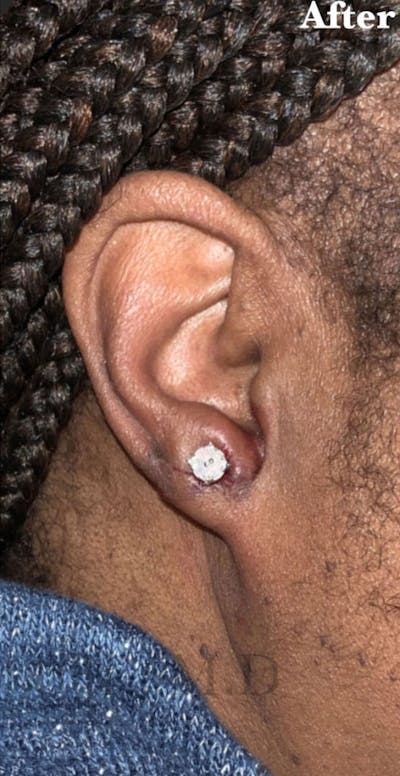 Ear Lobe Repair Before & After Gallery - Patient 219675 - Image 2