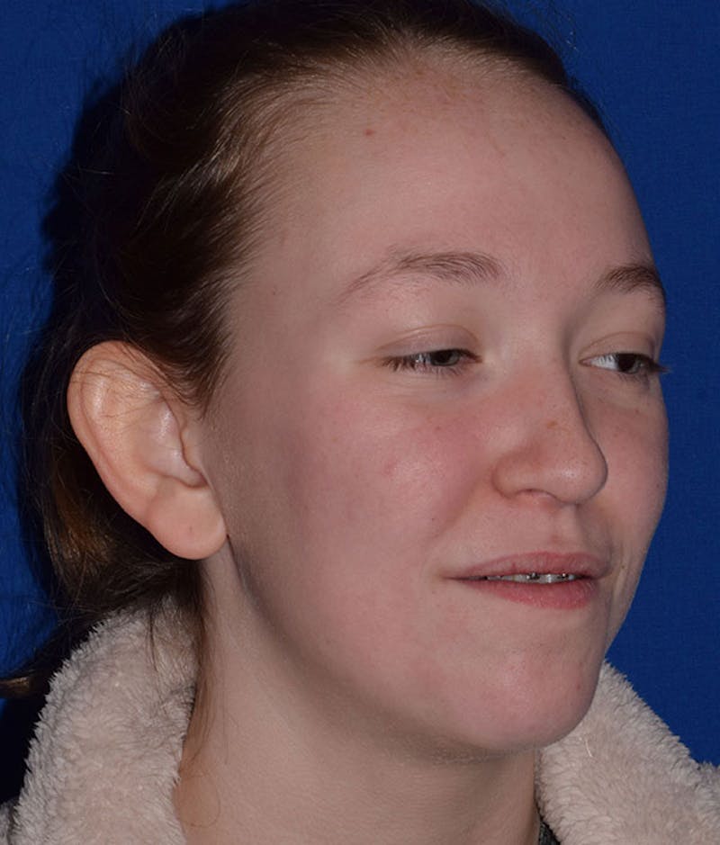 Otoplasty Before & After Gallery - Patient 402237 - Image 3
