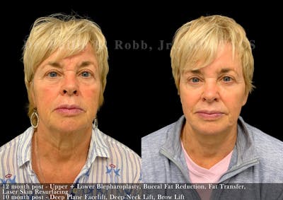 Upper Blepharoplasty Before & After Gallery - Patient 891551 - Image 1