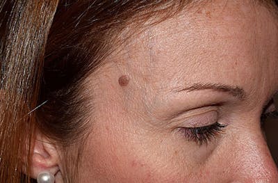 Skin Lesion Removal Before & After Gallery - Patient 210884 - Image 1