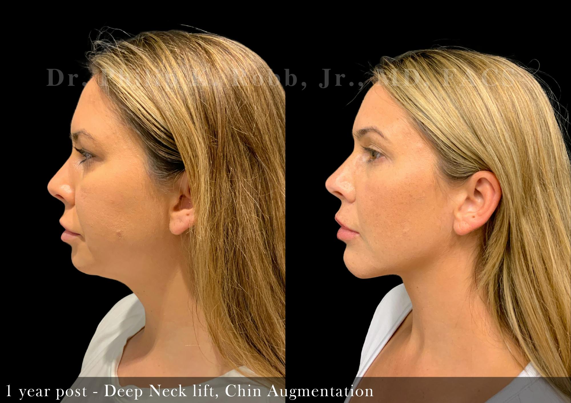 Chin Augmentation Before & After Gallery - Patient 288933 - Image 1