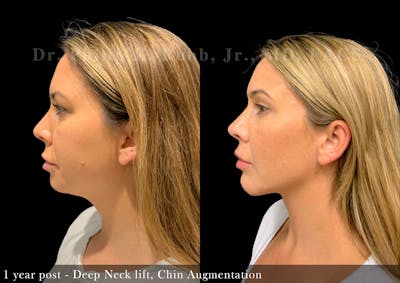Chin Augmentation Before & After Gallery - Patient 288933 - Image 1