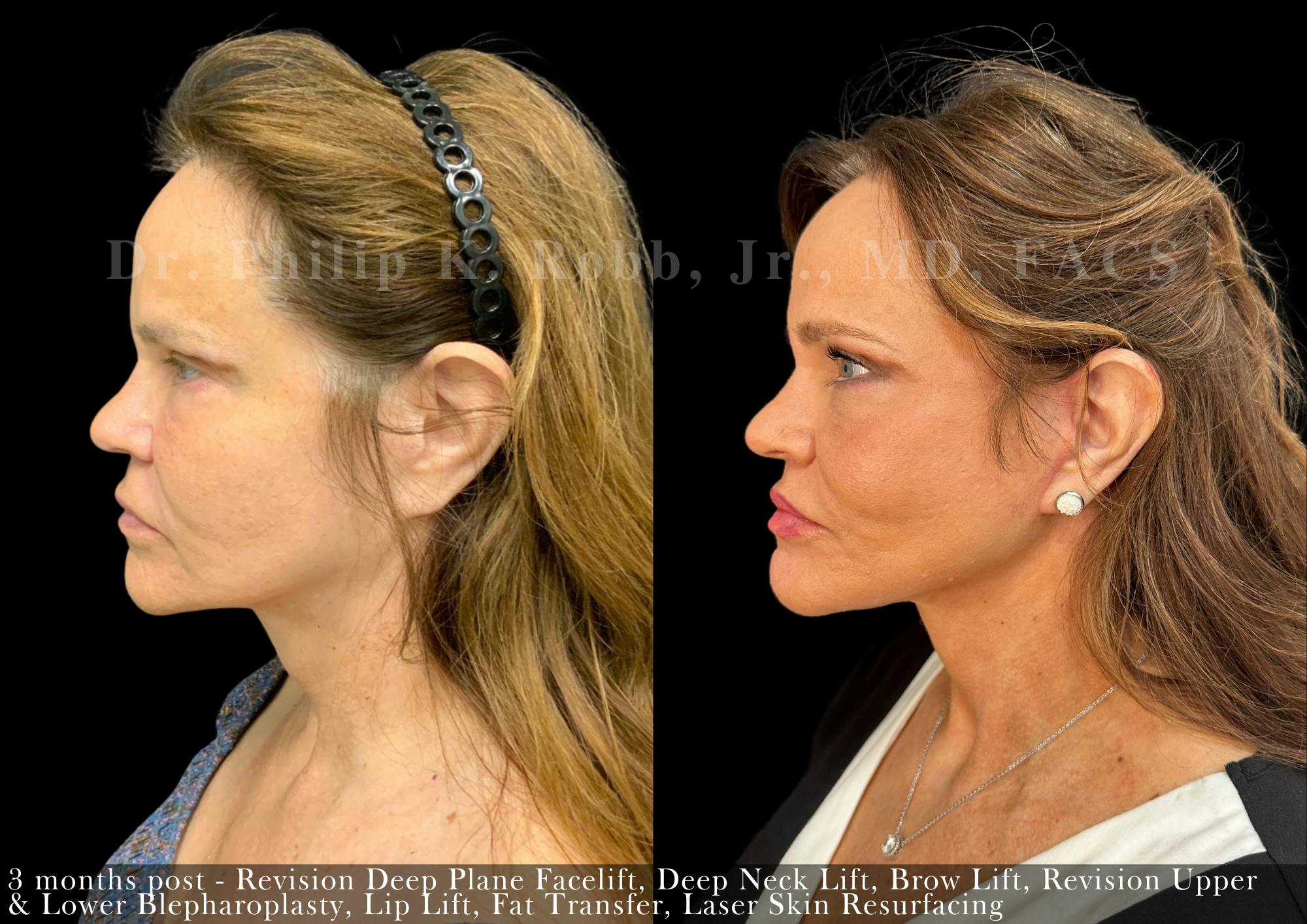 Facelift Before & After Gallery - Patient 694066 - Image 3