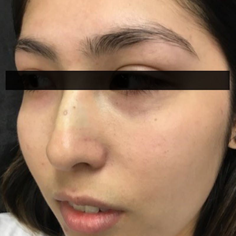 Skin Lesion Removal Before & After Gallery - Patient 316684 - Image 1