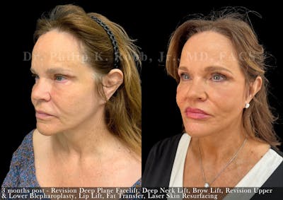 Facelift Before & After Gallery - Patient 694066 - Image 1