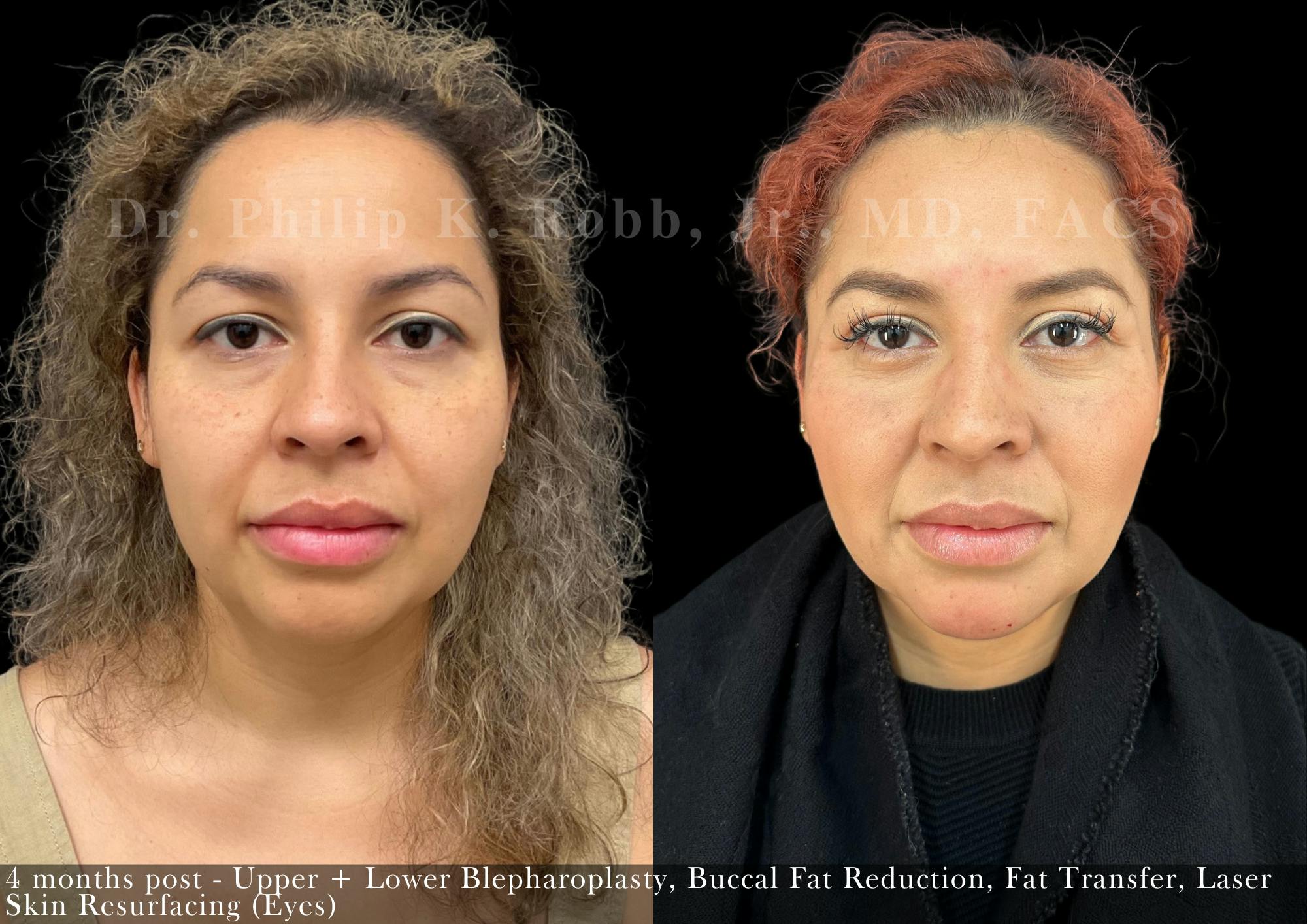 Lower Blepharoplasty Before & After Gallery - Patient 116078 - Image 1