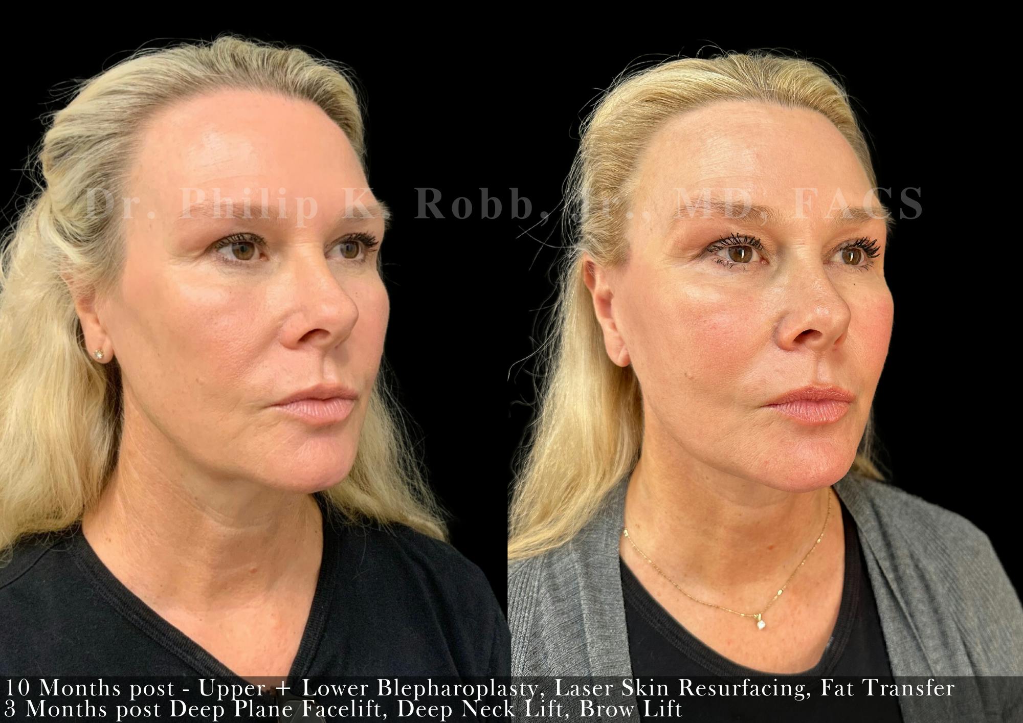 Brow Lift Before & After Gallery - Patient 147837 - Image 2
