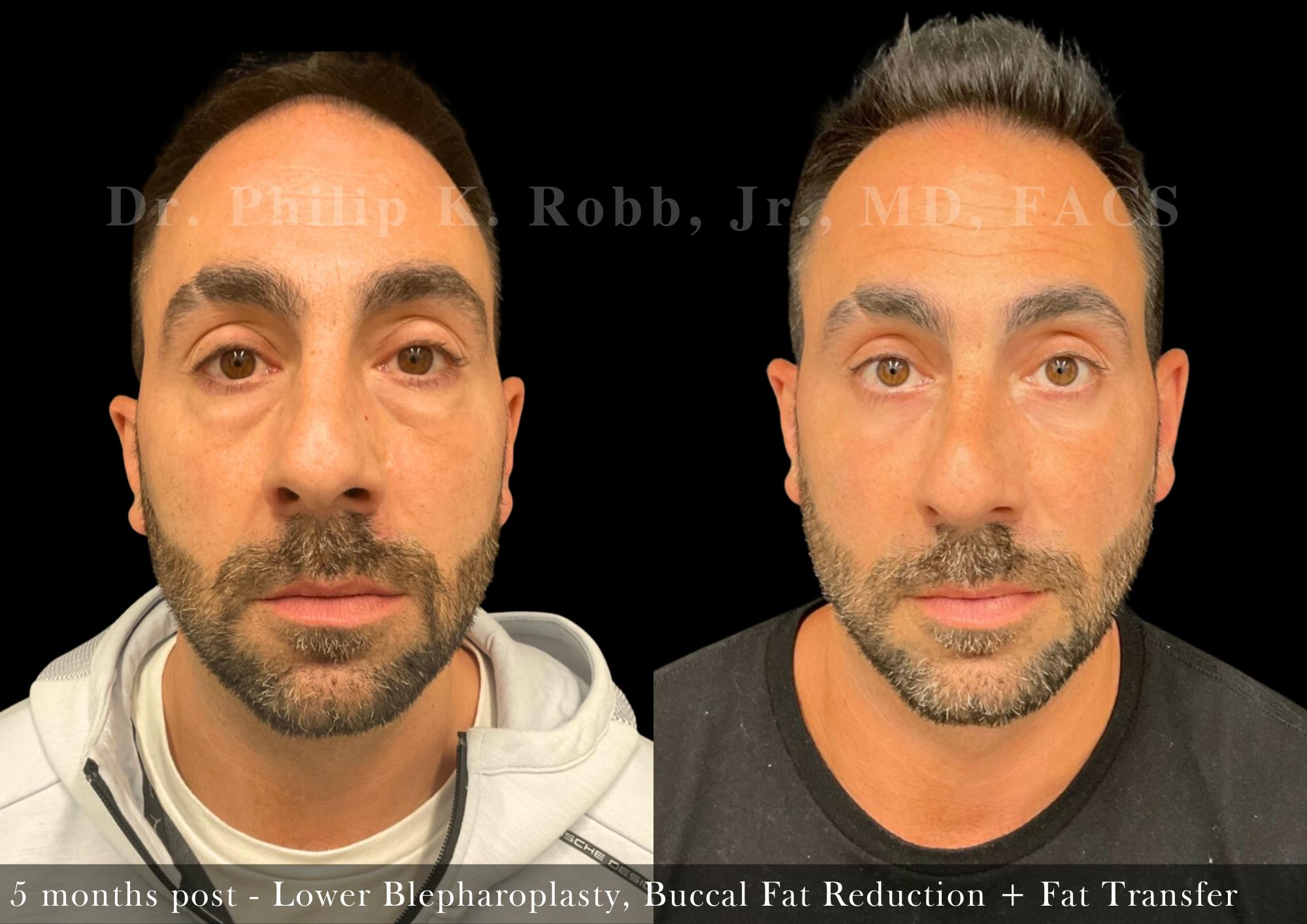 Buccal Fat Reduction Before & After Gallery - Patient 366707 - Image 1