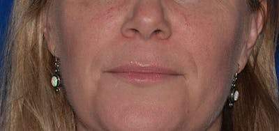 Dimpleplasty Before & After Gallery - Patient 218117 - Image 1