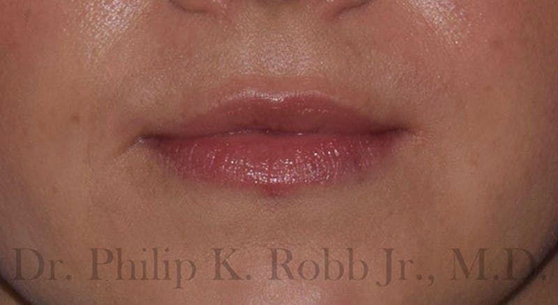 Skin Lesion Removal Before & After Gallery - Patient 649618 - Image 2