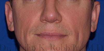 Otoplasty Before & After Gallery - Patient 298901 - Image 2