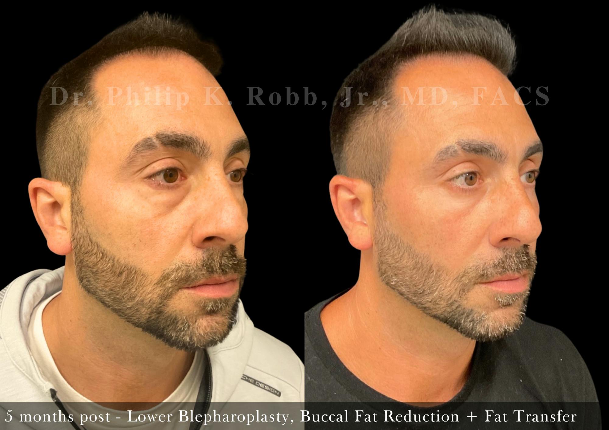 Buccal Fat Reduction Before & After Gallery - Patient 366707 - Image 3