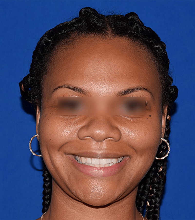 Dimpleplasty Before & After Gallery - Patient 233635 - Image 1
