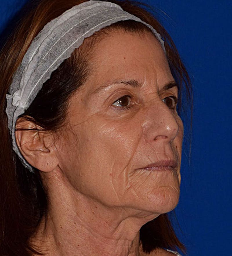 Facial Implants & Fat Transfer Before & After Gallery - Patient 641047 - Image 3