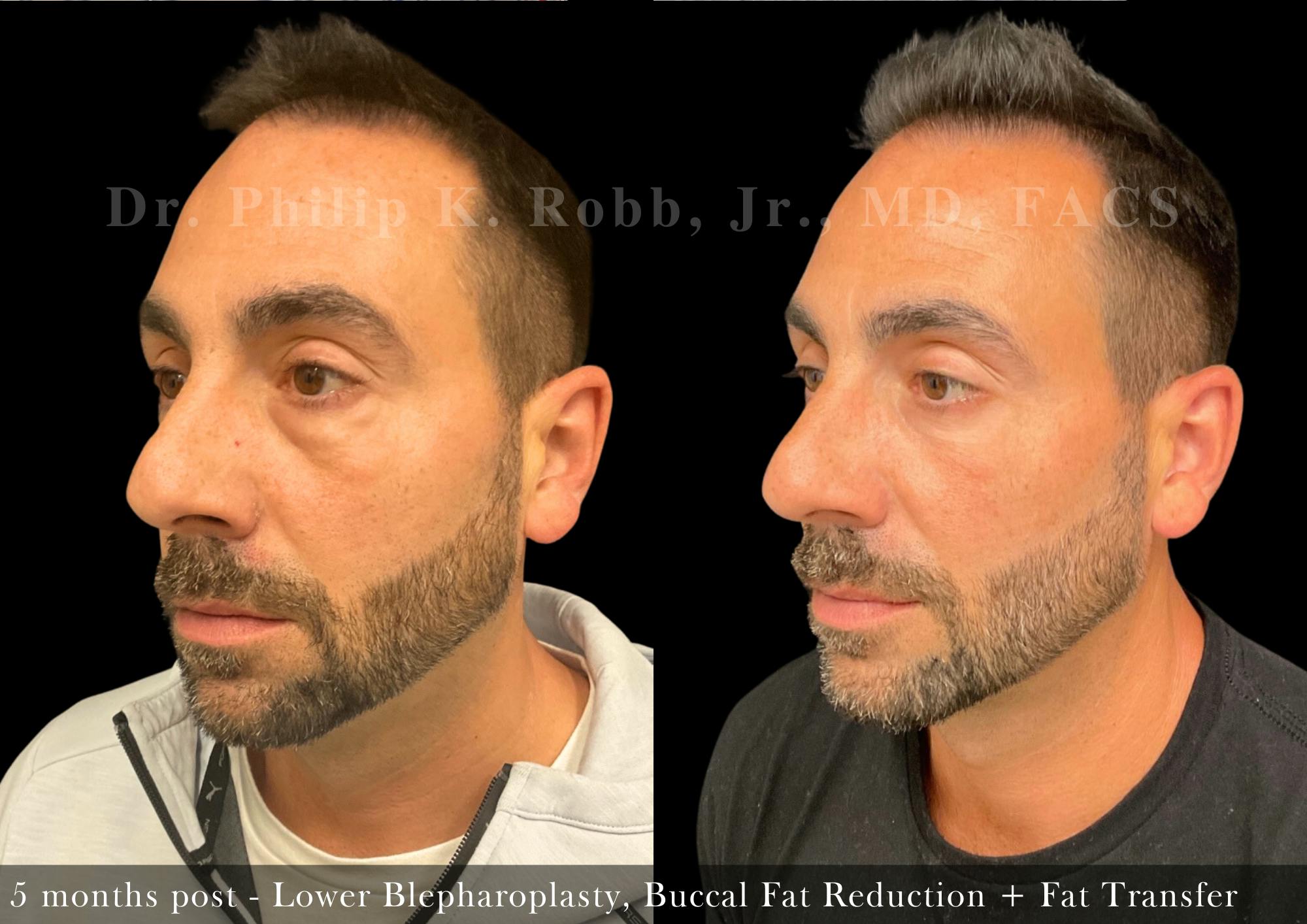 Buccal Fat Reduction Before & After Gallery - Patient 366707 - Image 2