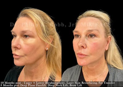 Facelift Before & After Gallery - Patient 150889 - Image 1