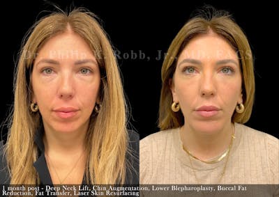 Buccal Fat Reduction Before & After Gallery - Patient 334269 - Image 1