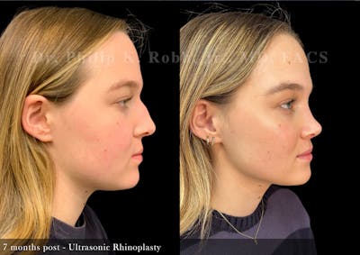 Ultrasonic Rhinoplasty Before & After Gallery - Patient 279060 - Image 1