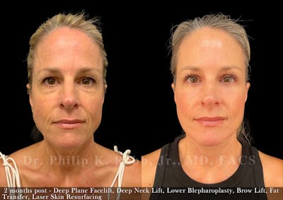 Brow Lift Before & After Gallery - Patient 158459 - Image 1