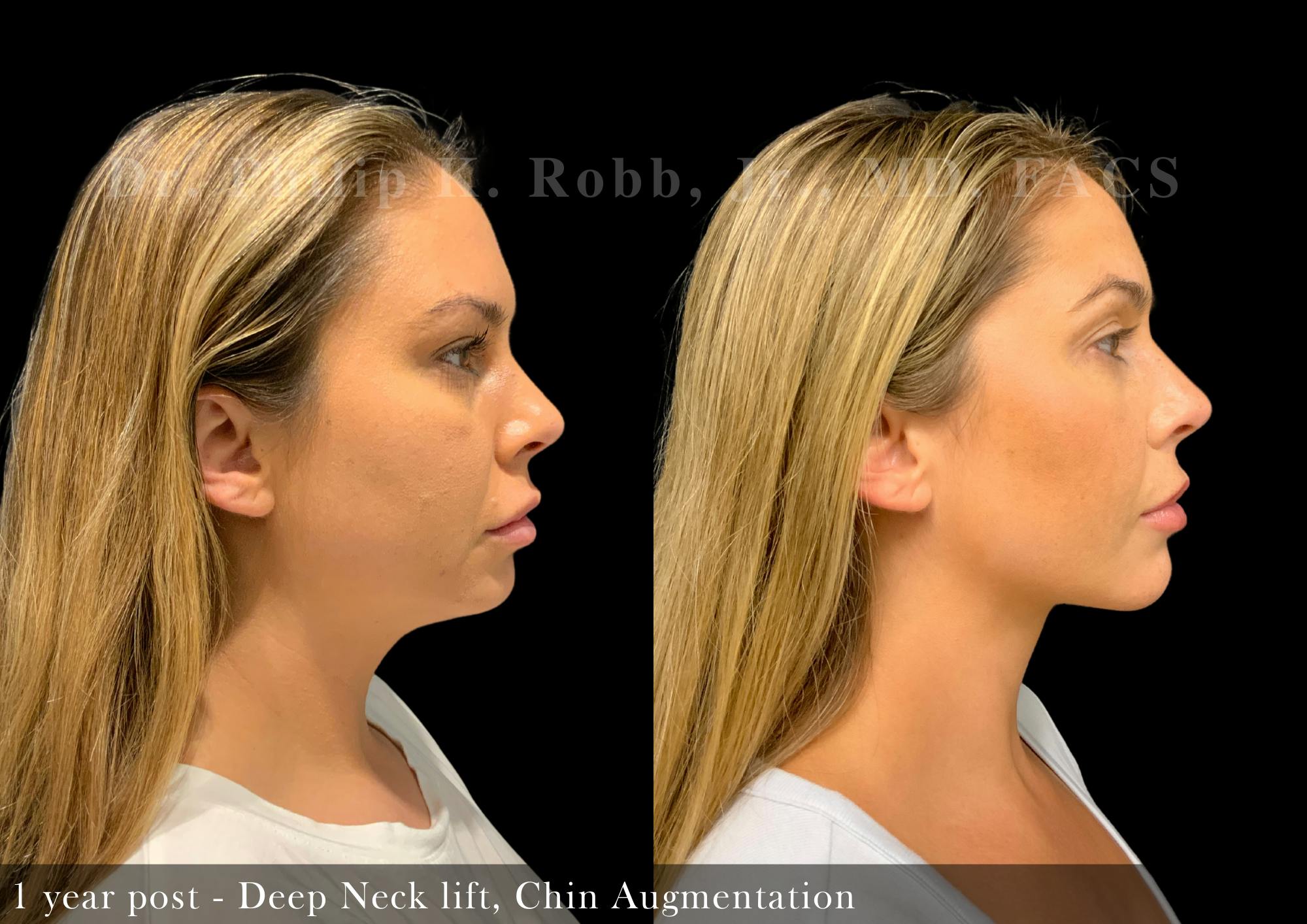 Chin Augmentation Before & After Gallery - Patient 288933 - Image 5