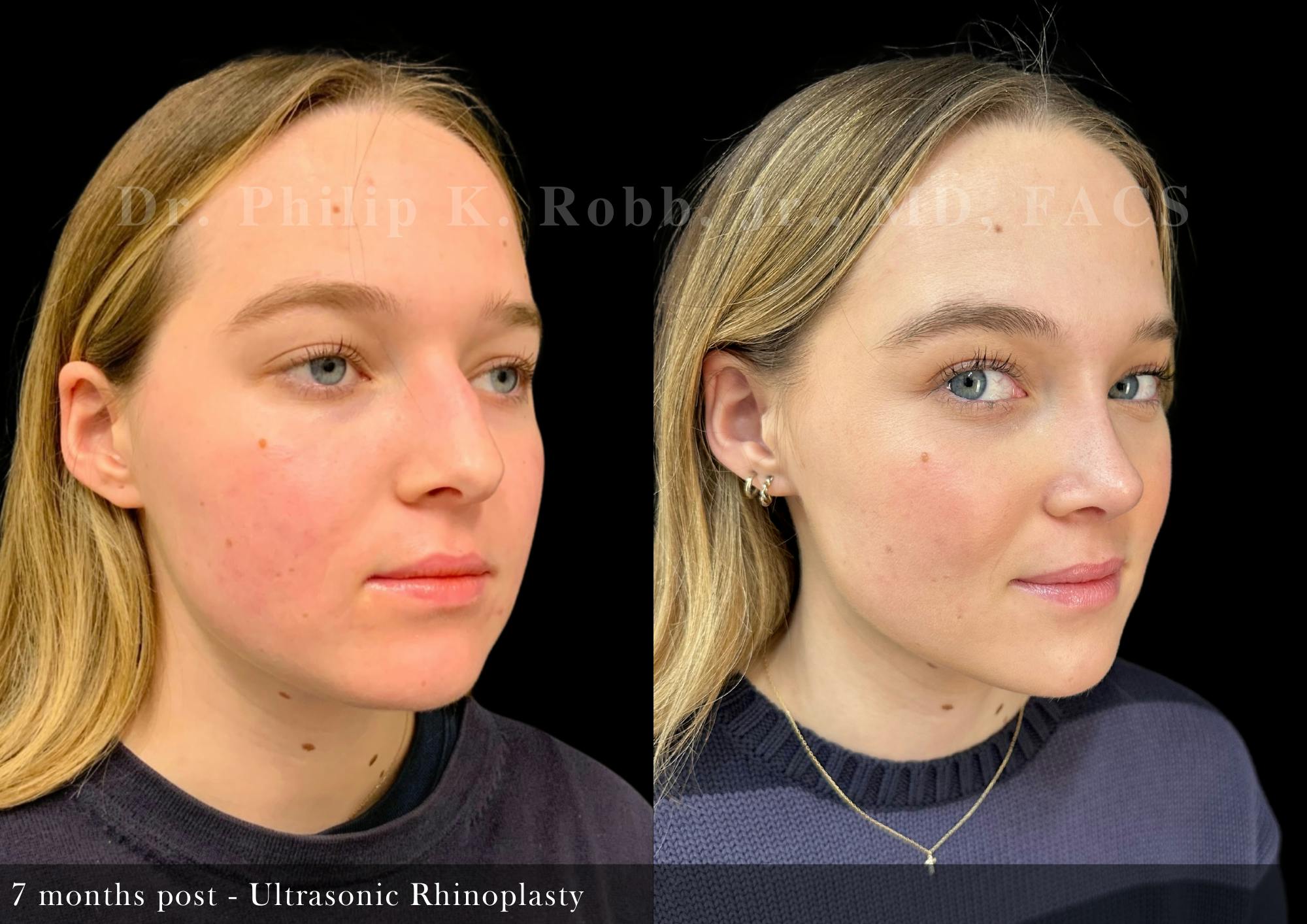 Ultrasonic Rhinoplasty Before & After Gallery - Patient 279060 - Image 2