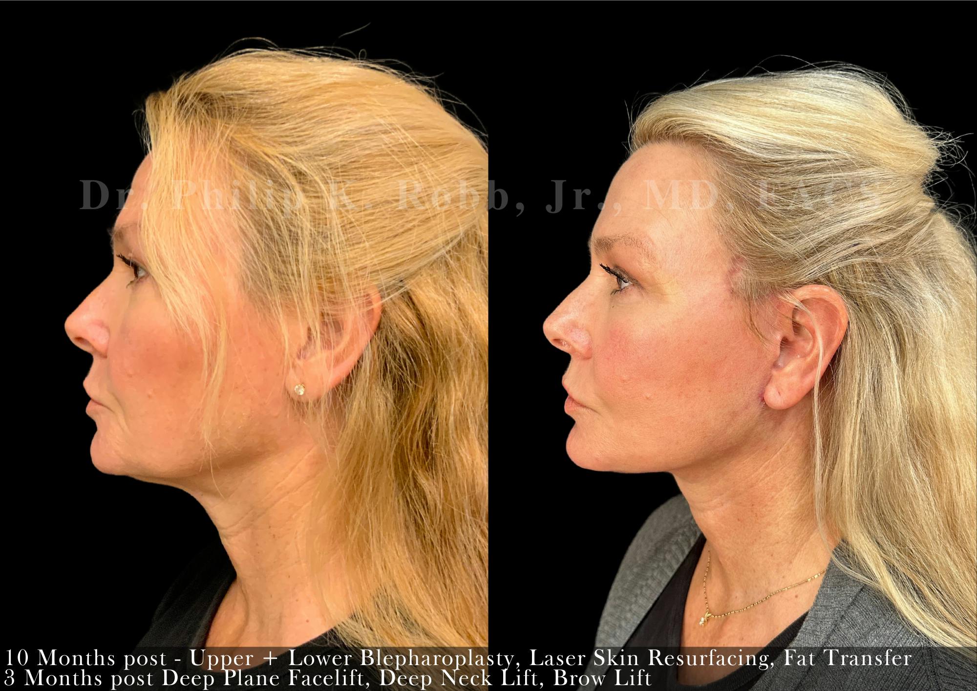 Neck Lift Before & After Gallery - Patient 293333 - Image 1