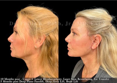 Neck Lift Before & After Gallery - Patient 293333 - Image 1
