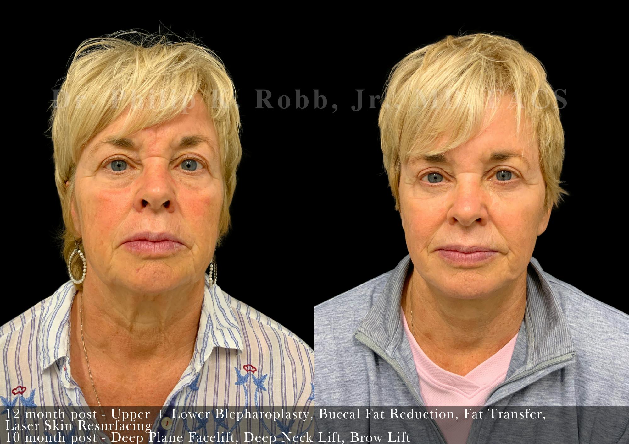 Lower Blepharoplasty Before & After Gallery - Patient 351455 - Image 1