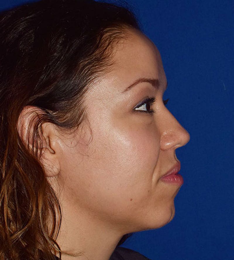 Facial Implants & Fat Transfer Before & After Gallery - Patient 147792 - Image 6