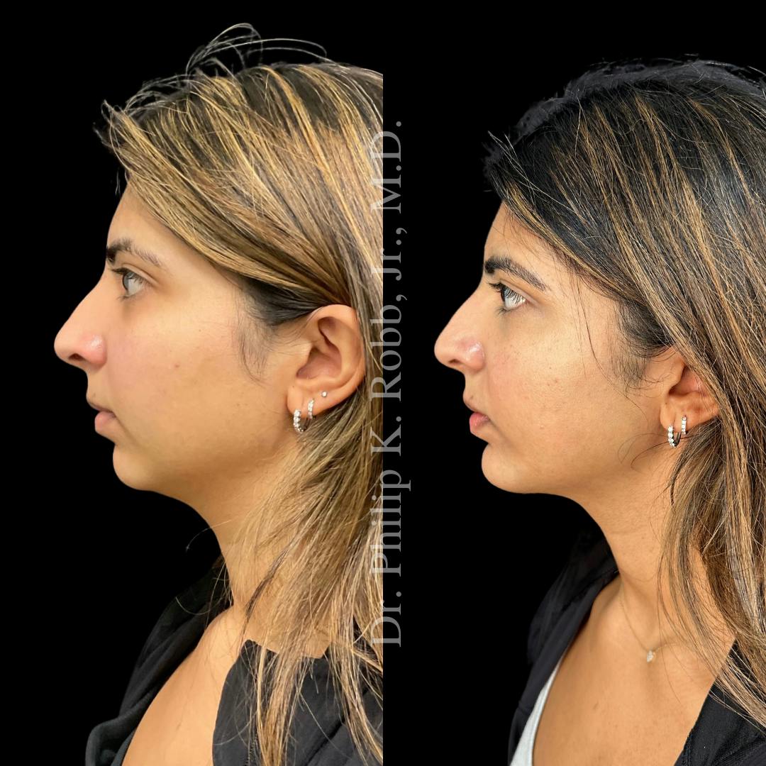 Chin Augmentation Before & After Gallery - Patient 129972 - Image 1