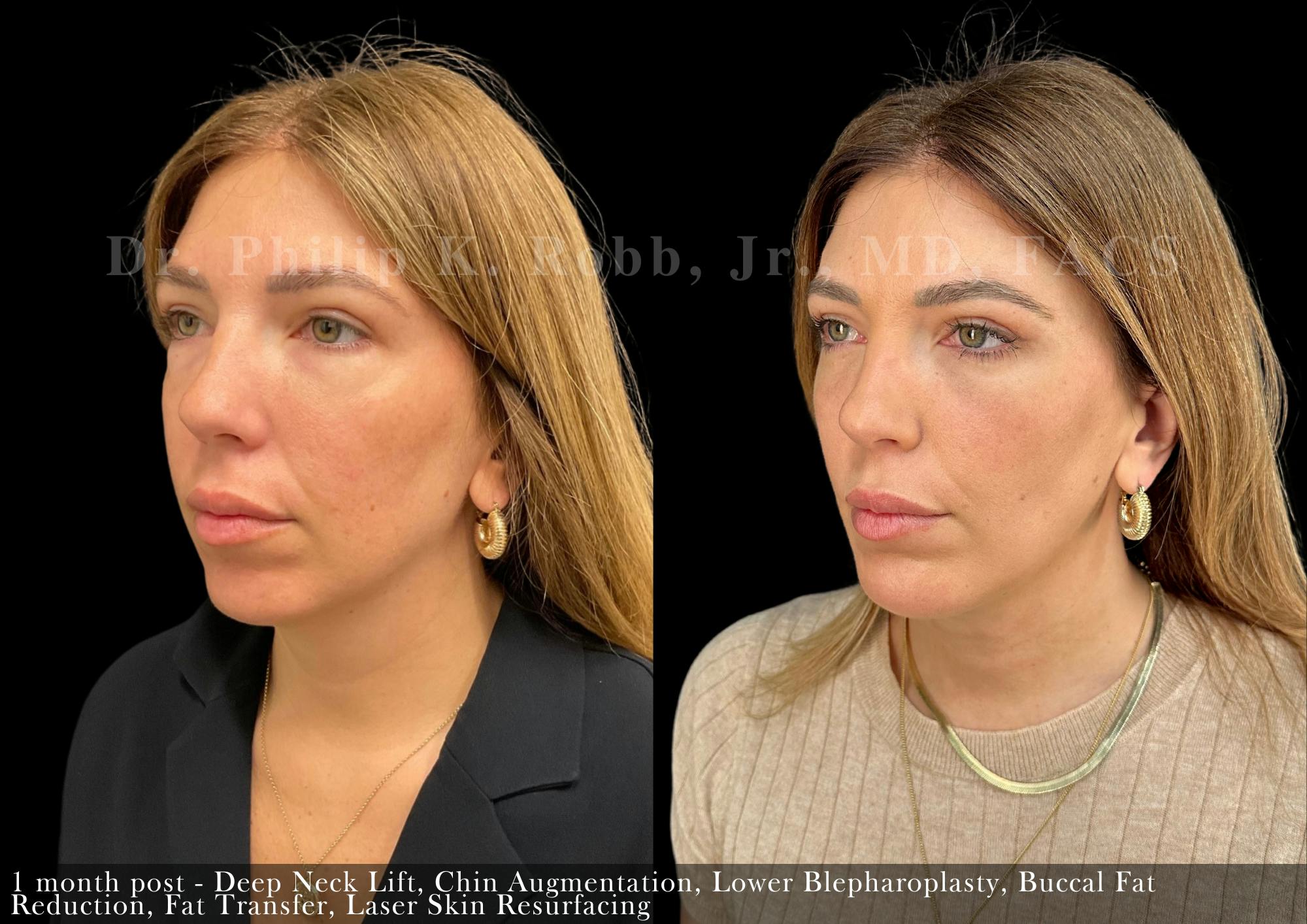Buccal Fat Reduction Before & After Gallery - Patient 334269 - Image 3