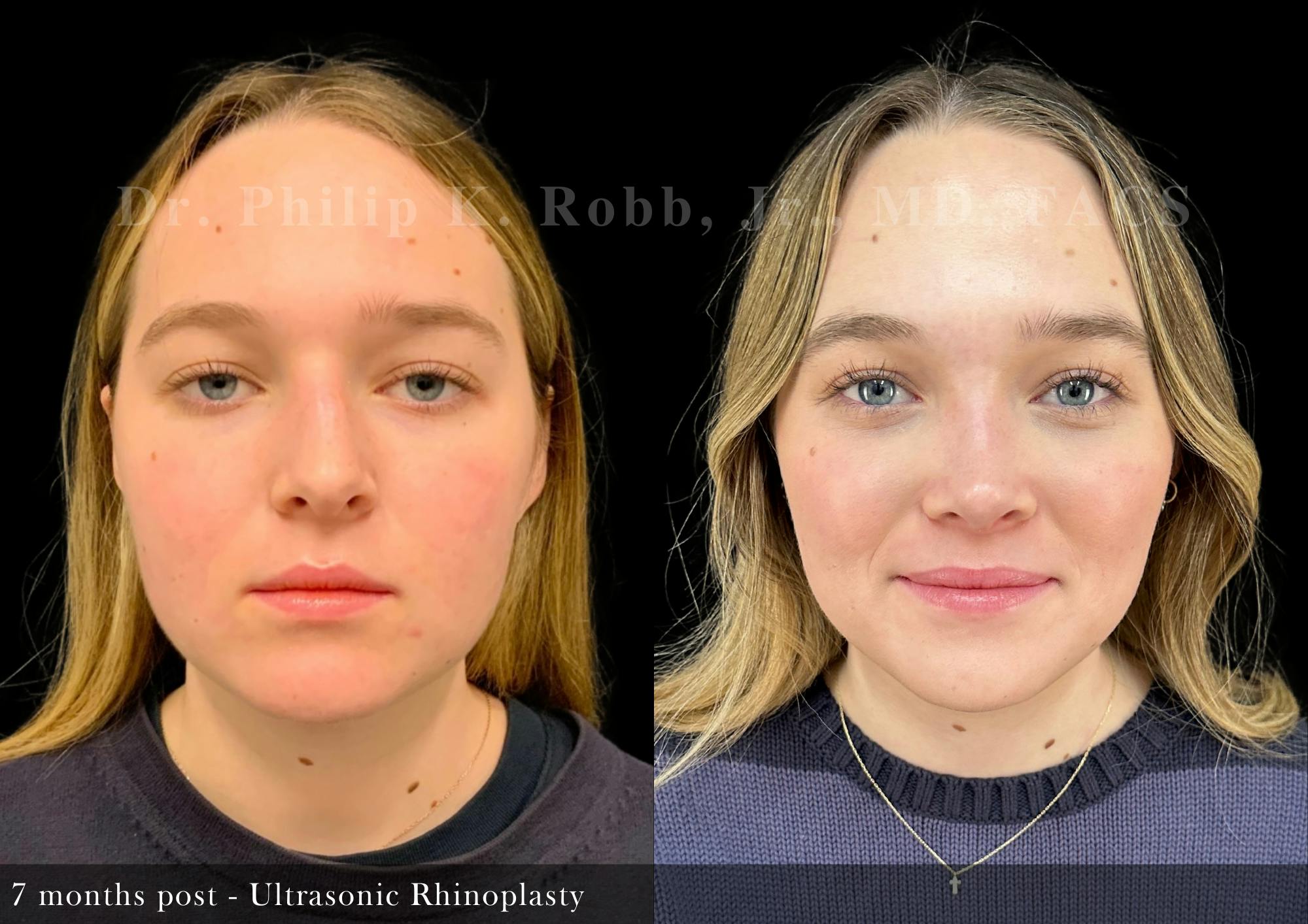 Ultrasonic Rhinoplasty Before & After Gallery - Patient 279060 - Image 3