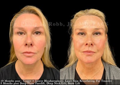 Fat Transfer Before & After Gallery - Patient 280516 - Image 1