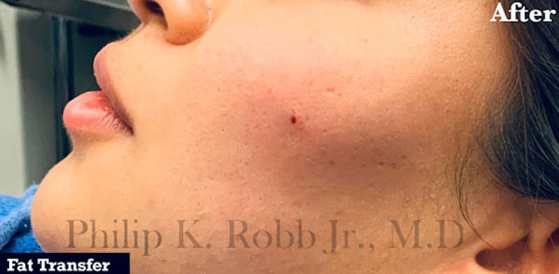 Facial Implants & Fat Transfer Before & After Gallery - Patient 887179 - Image 2